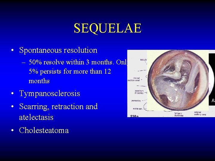 SEQUELAE • Spontaneous resolution – 50% resolve within 3 months. Only 5% persists for