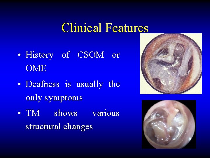 Clinical Features • History of CSOM or OME • Deafness is usually the only