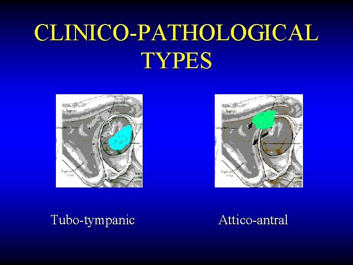 CLINICO-PATHOLOGICAL TYPES Tubo-tympanic Attico-antral 