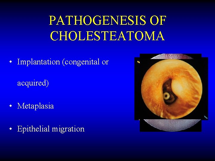 PATHOGENESIS OF CHOLESTEATOMA • Implantation (congenital or acquired) • Metaplasia • Epithelial migration 