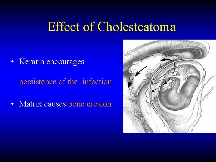 Effect of Cholesteatoma • Keratin encourages persistence of the infection • Matrix causes bone