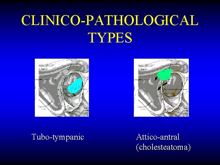 CLINICO-PATHOLOGICAL TYPES Tubo-tympanic Attico-antral (cholesteatoma) 