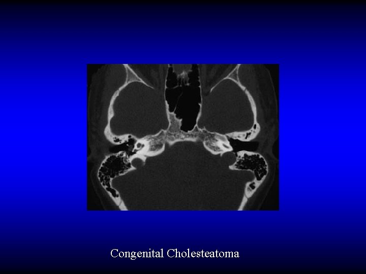 Congenital Cholesteatoma 