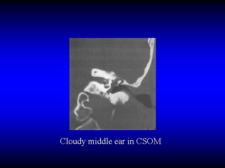 Cloudy middle ear in CSOM 