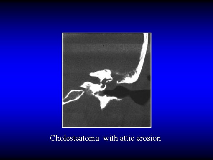 Cholesteatoma with attic erosion 