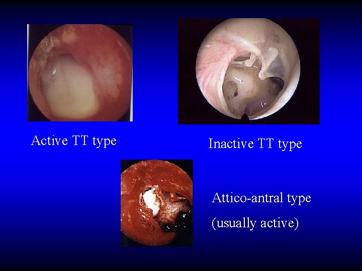 Active TT type Inactive TT type Attico-antral type (usually active) 