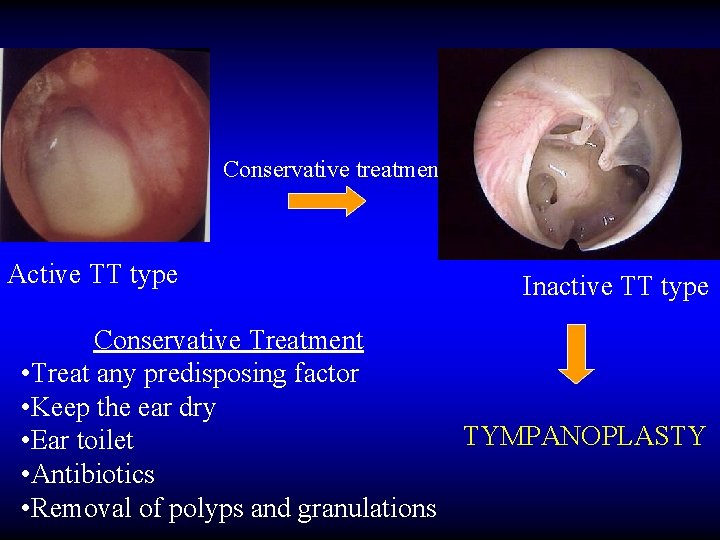 Conservative treatment Active TT type Inactive TT type Conservative Treatment • Treat any predisposing