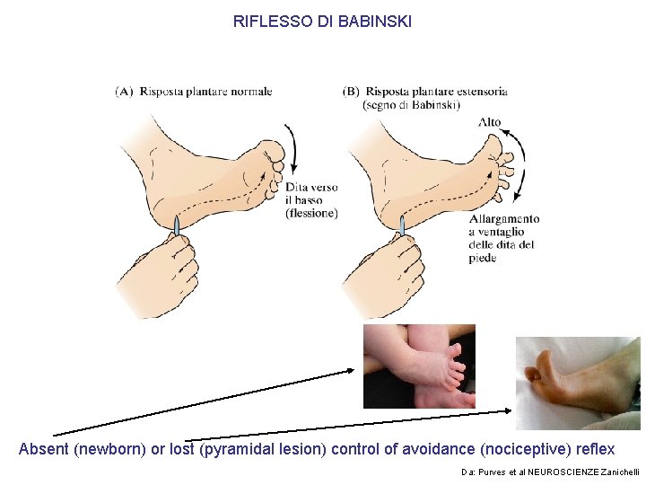 RIFLESSO DI BABINSKI Absent (newborn) or lost (pyramidal lesion) control of avoidance (nociceptive) reflex