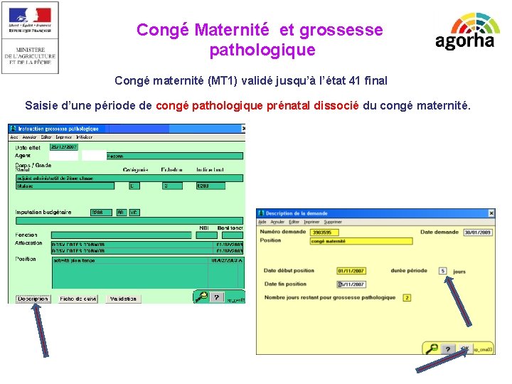 Congé Maternité et grossesse pathologique Congé maternité (MT 1) validé jusqu’à l’état 41 final