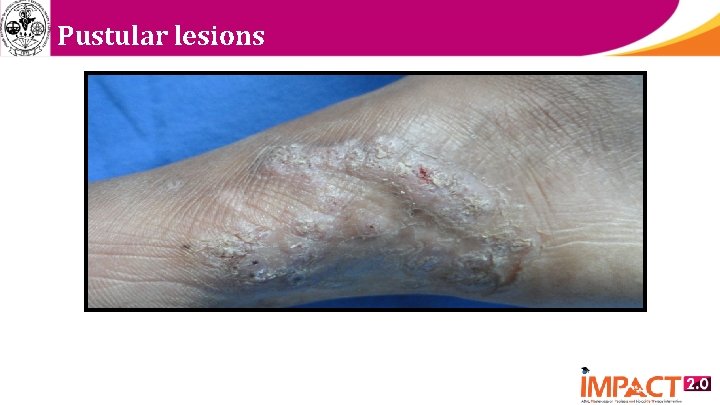 Pustular lesions 