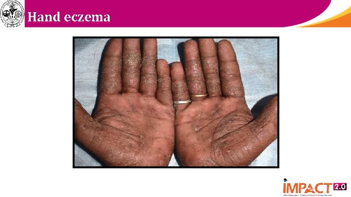 Hand eczema 17 