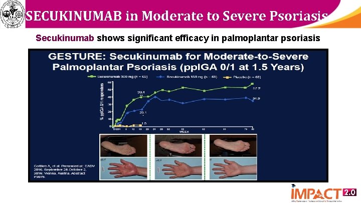 SECUKINUMAB in Moderate to Severe Psoriasis Secukinumab shows significant efficacy in palmoplantar psoriasis 