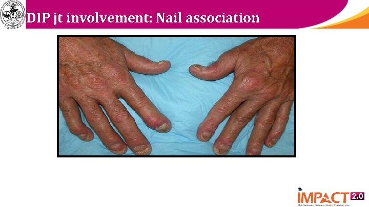 DIP jt involvement: Nail association 