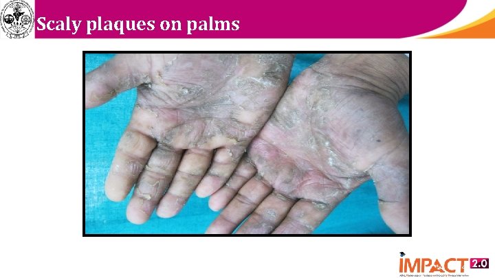 Scaly plaques on palms 4 