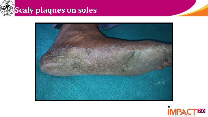 Scaly plaques on soles 5 