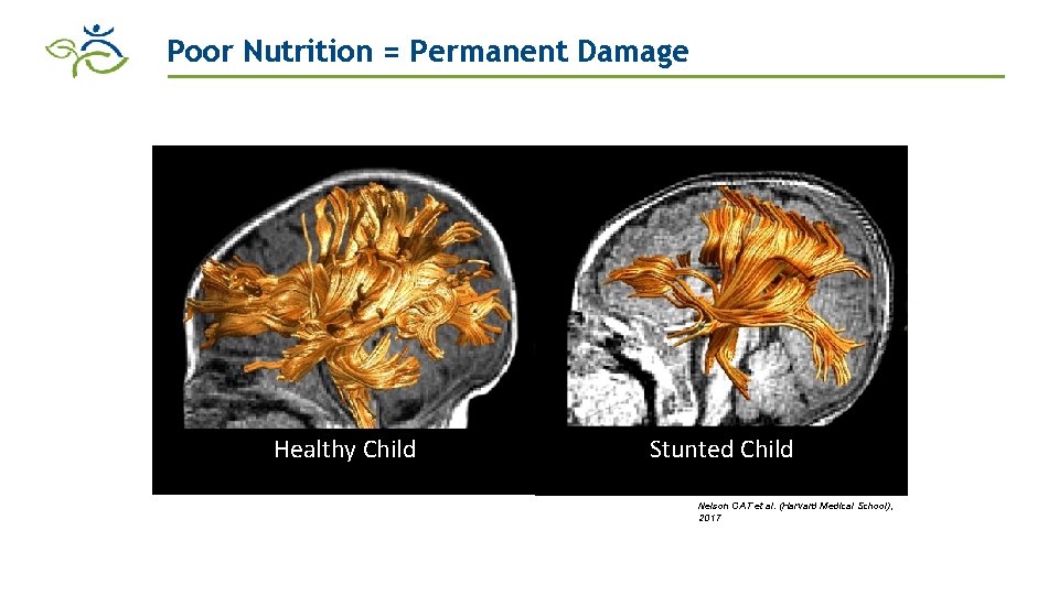 Poor Nutrition = Permanent Damage • World Development Report, 2016. World Bank CHILD WITH