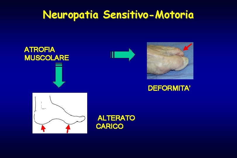 Neuropatia Sensitivo-Motoria ATROFIA MUSCOLARE DEFORMITA’ ALTERATO CARICO 
