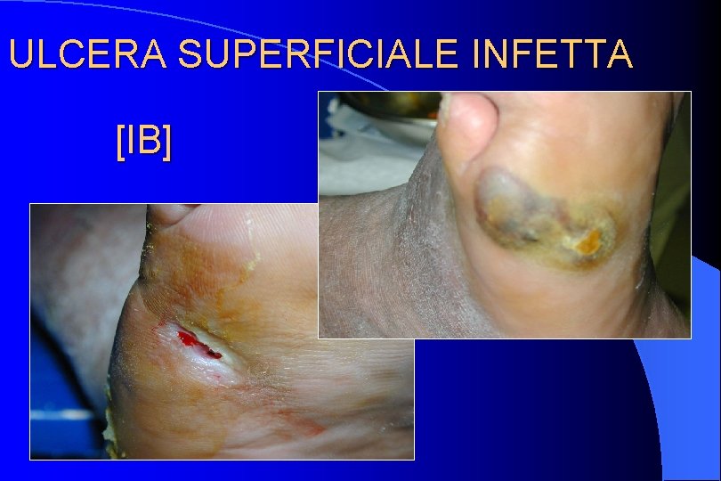 ULCERA SUPERFICIALE INFETTA [IB] 