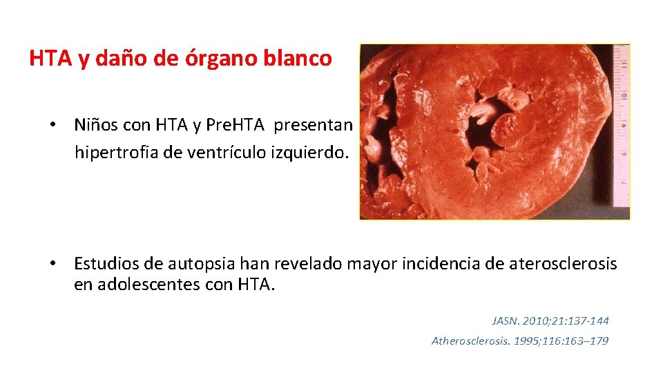 HTA y daño de órgano blanco • Niños con HTA y Pre. HTA presentan
