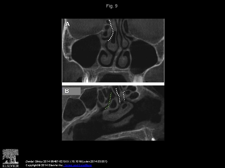 Fig. 9 Dental Clinics 2014 58497 -521 DOI: (10. 1016/j. cden. 2014. 03. 001)