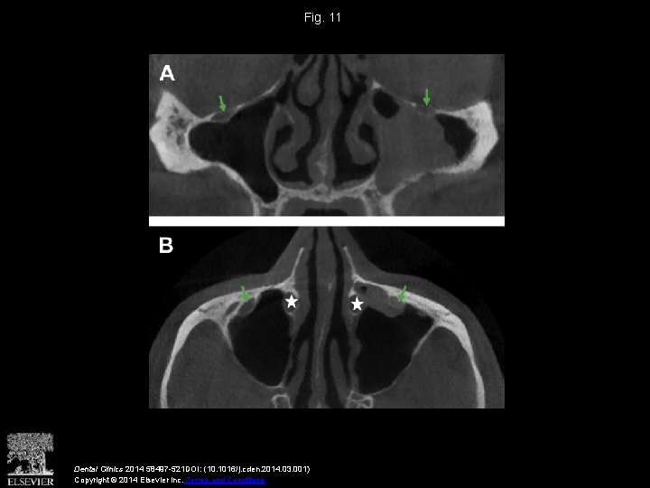 Fig. 11 Dental Clinics 2014 58497 -521 DOI: (10. 1016/j. cden. 2014. 03. 001)