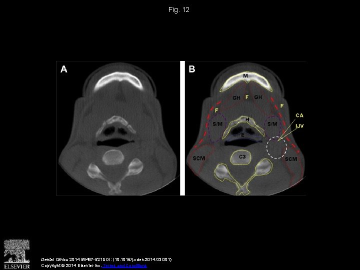 Fig. 12 Dental Clinics 2014 58497 -521 DOI: (10. 1016/j. cden. 2014. 03. 001)