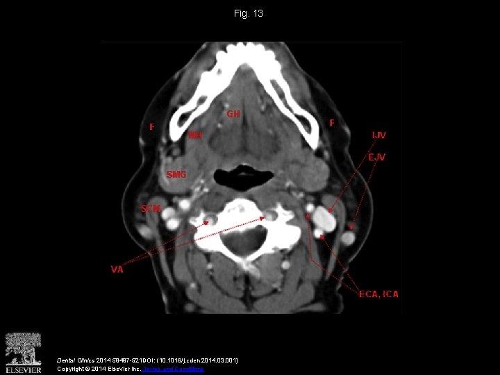 Fig. 13 Dental Clinics 2014 58497 -521 DOI: (10. 1016/j. cden. 2014. 03. 001)
