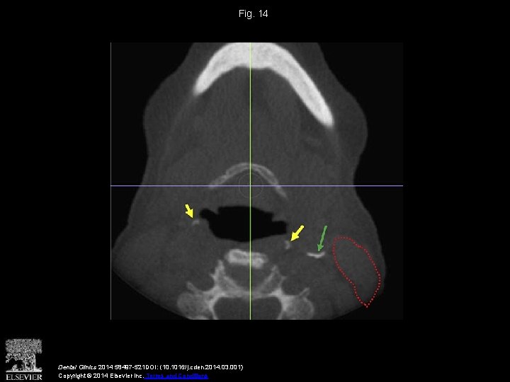 Fig. 14 Dental Clinics 2014 58497 -521 DOI: (10. 1016/j. cden. 2014. 03. 001)