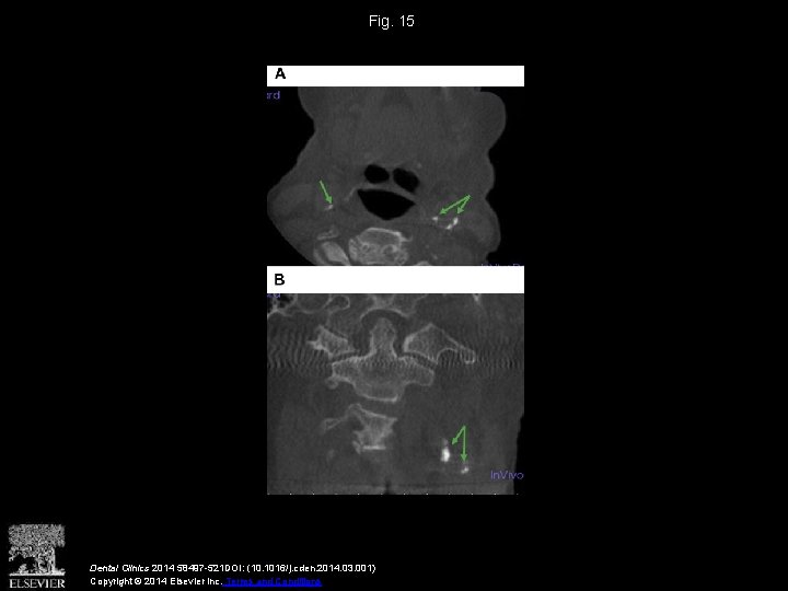 Fig. 15 Dental Clinics 2014 58497 -521 DOI: (10. 1016/j. cden. 2014. 03. 001)