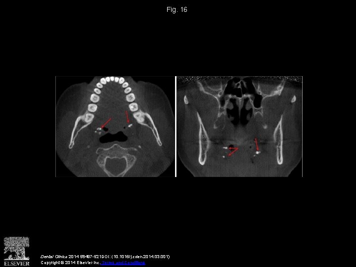 Fig. 16 Dental Clinics 2014 58497 -521 DOI: (10. 1016/j. cden. 2014. 03. 001)