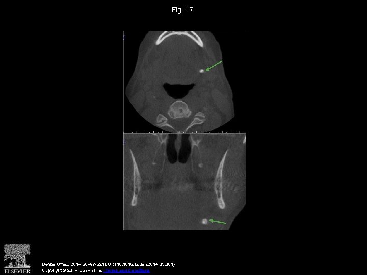 Fig. 17 Dental Clinics 2014 58497 -521 DOI: (10. 1016/j. cden. 2014. 03. 001)