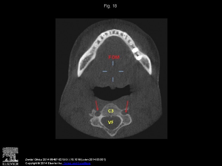 Fig. 18 Dental Clinics 2014 58497 -521 DOI: (10. 1016/j. cden. 2014. 03. 001)