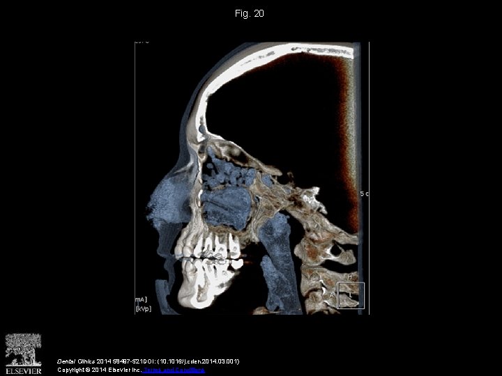 Fig. 20 Dental Clinics 2014 58497 -521 DOI: (10. 1016/j. cden. 2014. 03. 001)