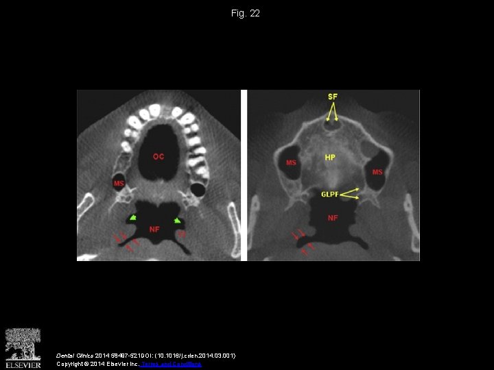 Fig. 22 Dental Clinics 2014 58497 -521 DOI: (10. 1016/j. cden. 2014. 03. 001)