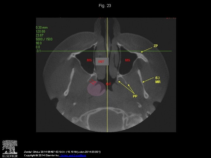Fig. 23 Dental Clinics 2014 58497 -521 DOI: (10. 1016/j. cden. 2014. 03. 001)