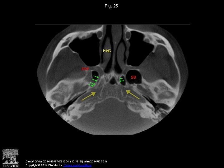 Fig. 25 Dental Clinics 2014 58497 -521 DOI: (10. 1016/j. cden. 2014. 03. 001)