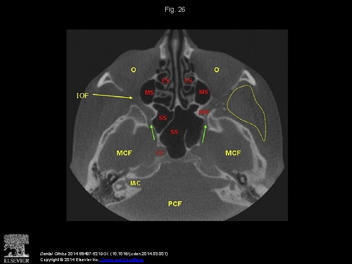 Fig. 26 Dental Clinics 2014 58497 -521 DOI: (10. 1016/j. cden. 2014. 03. 001)