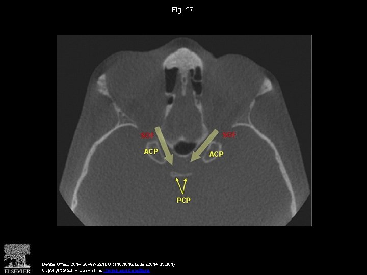 Fig. 27 Dental Clinics 2014 58497 -521 DOI: (10. 1016/j. cden. 2014. 03. 001)