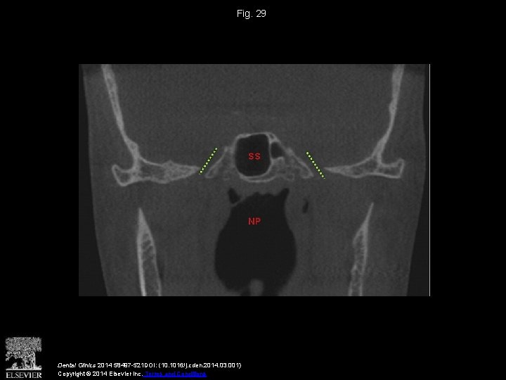 Fig. 29 Dental Clinics 2014 58497 -521 DOI: (10. 1016/j. cden. 2014. 03. 001)