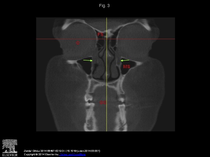 Fig. 3 Dental Clinics 2014 58497 -521 DOI: (10. 1016/j. cden. 2014. 03. 001)