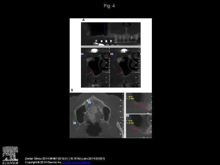 Fig. 4 Dental Clinics 2014 58497 -521 DOI: (10. 1016/j. cden. 2014. 03. 001)