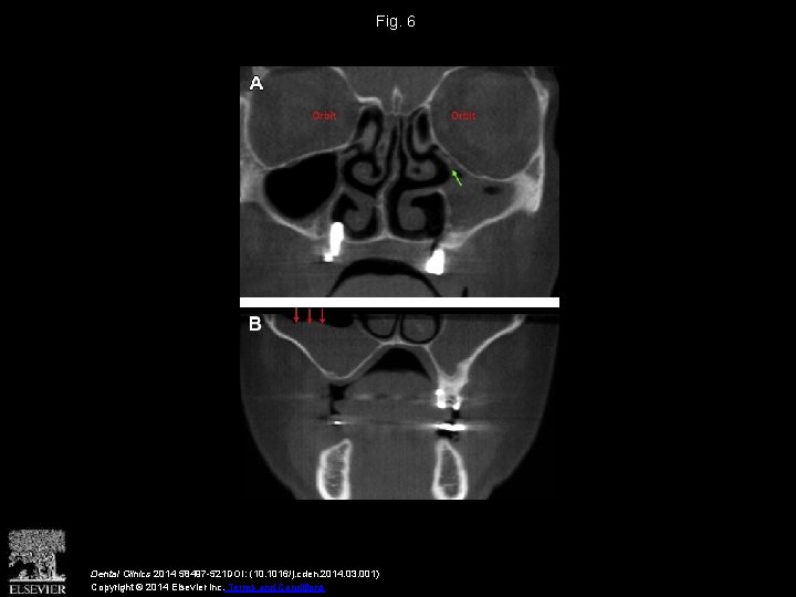 Fig. 6 Dental Clinics 2014 58497 -521 DOI: (10. 1016/j. cden. 2014. 03. 001)