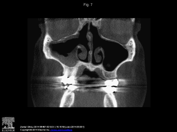 Fig. 7 Dental Clinics 2014 58497 -521 DOI: (10. 1016/j. cden. 2014. 03. 001)