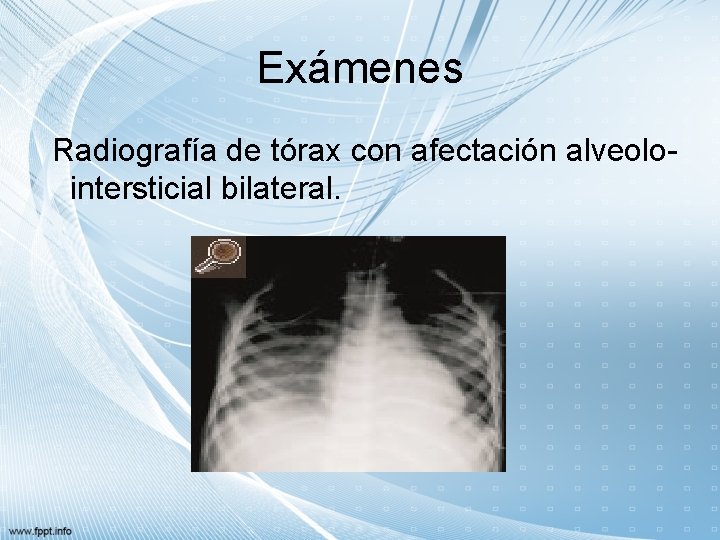 Exámenes Radiografía de tórax con afectación alveolo intersticial bilateral. 