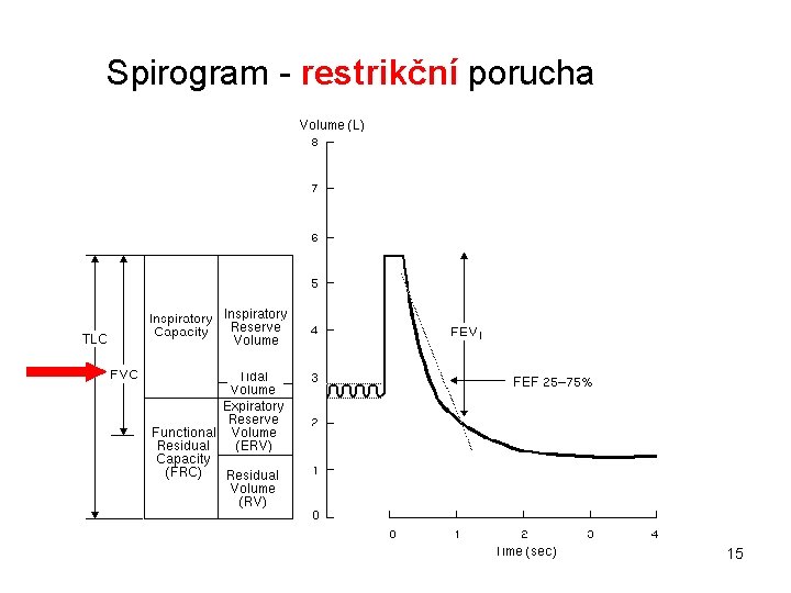 Spirogram - restrikční porucha 15 