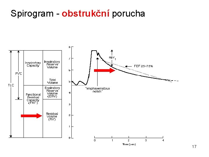 Spirogram - obstrukční porucha 17 