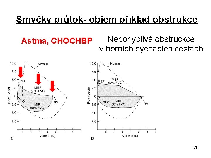 Smyčky průtok- objem příklad obstrukce Astma, CHOCHBP Nepohyblivá obstruckce v horních dýchacích cestách 20