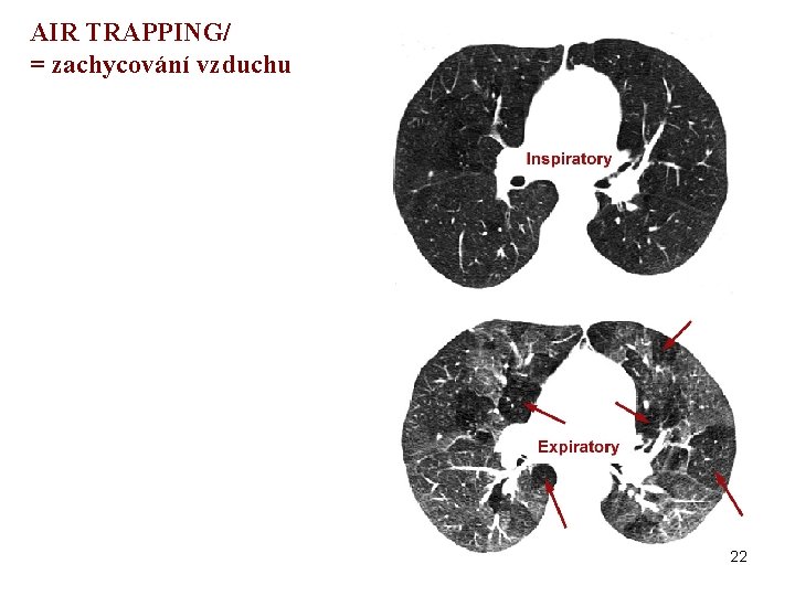 AIR TRAPPING/ = zachycování vzduchu 22 