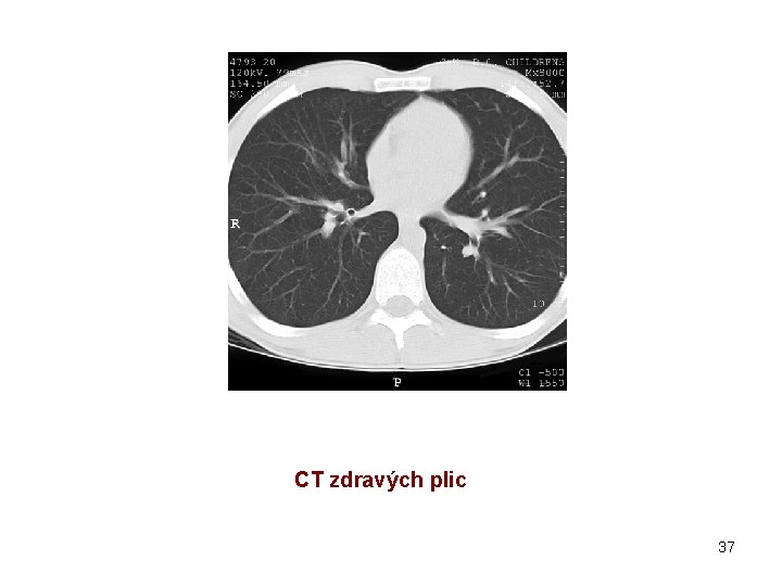 CT zdravých plic 37 