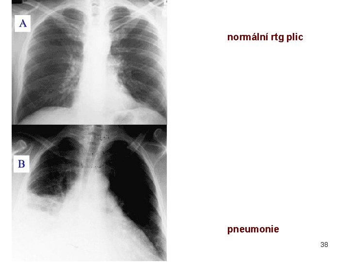 normální rtg plic pneumonie 38 